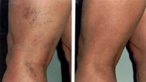 Laser Treatment for Spider Veins