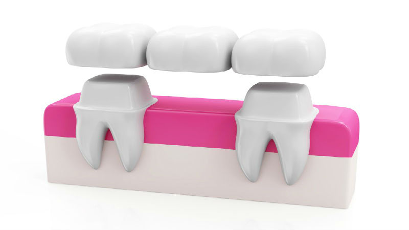 Dental Bridges Atlanta