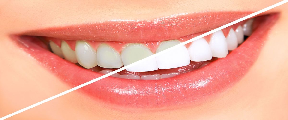 Straighten your smile with clear braces