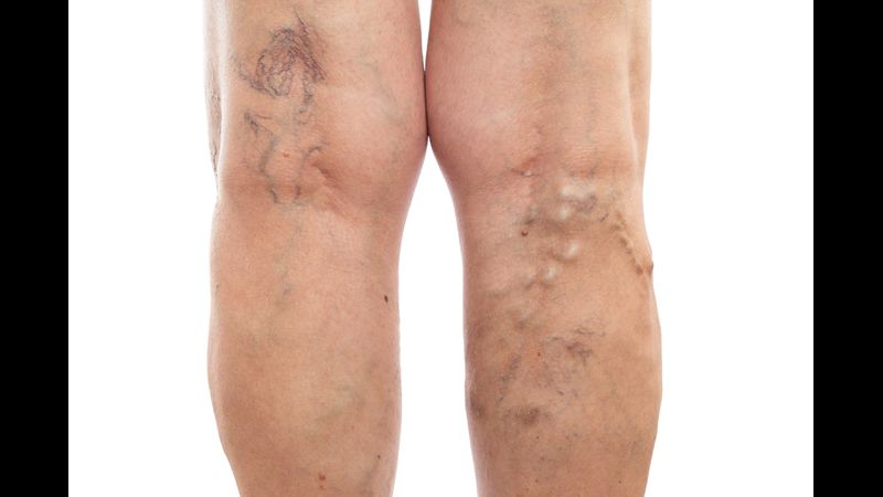 Vein Doctor Bensalem PA