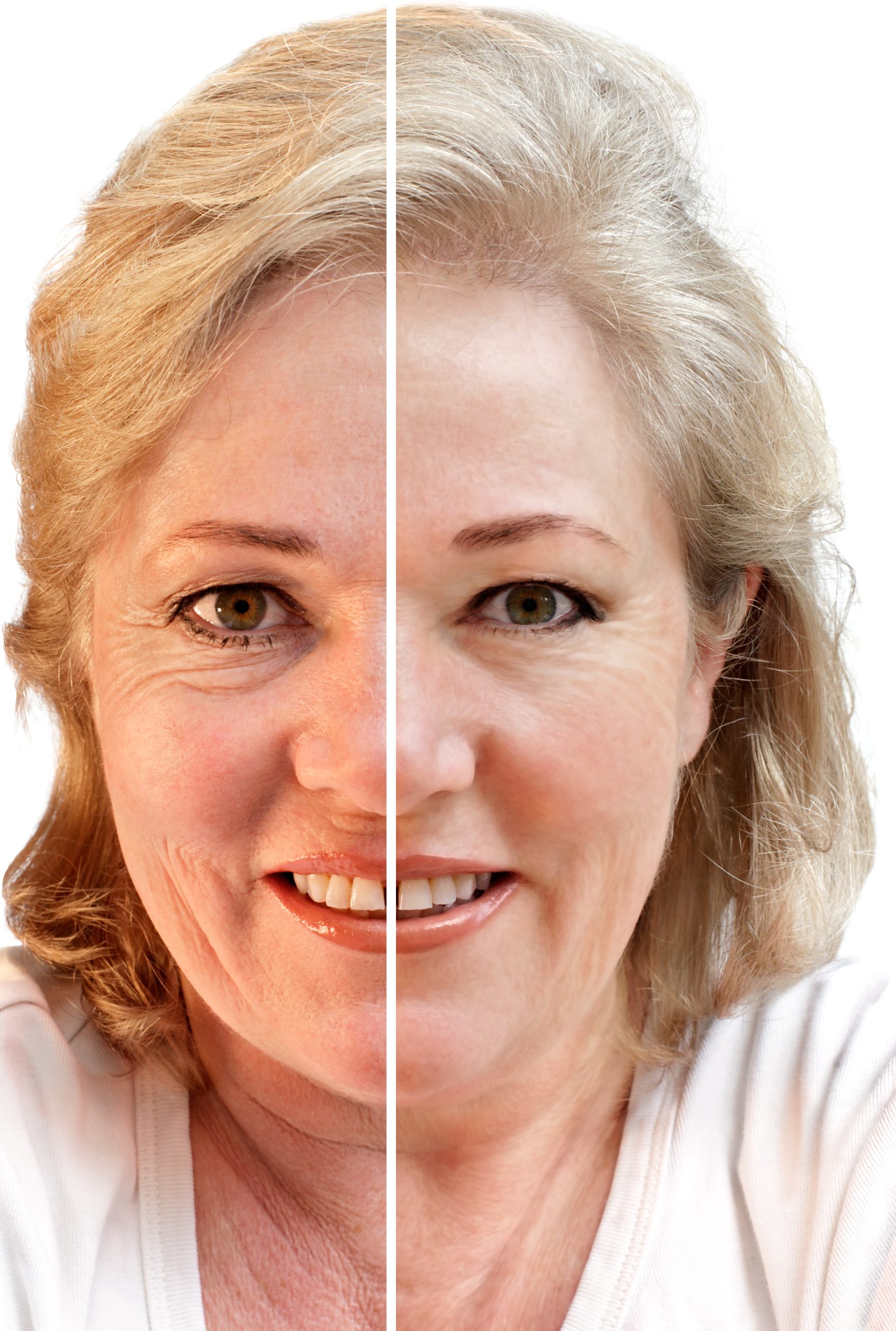 Vampire Facelift Yakima WA