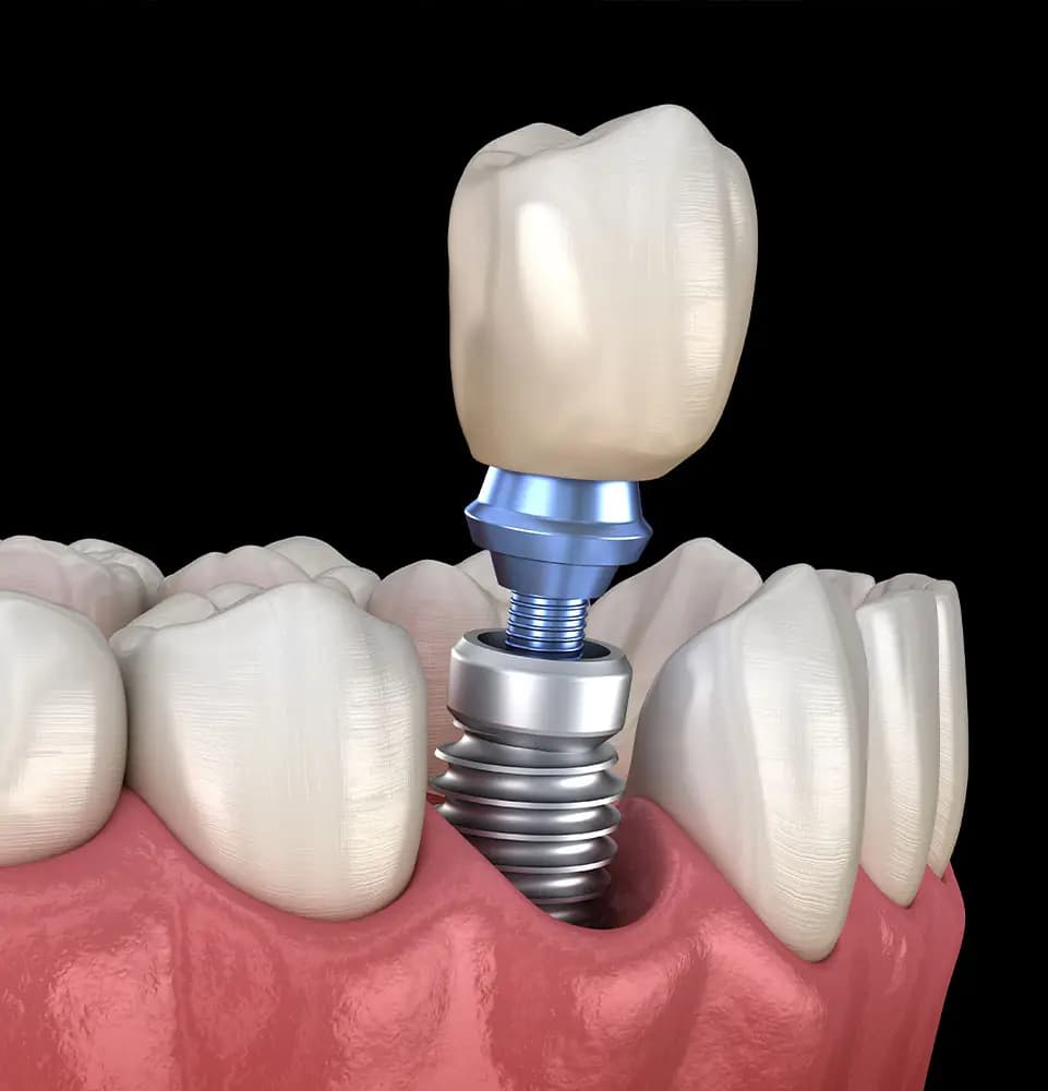 Visiting Atlanta Cosmetic Dentists To Get A Perfect Smile